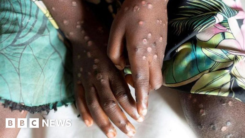 Mpox not new Covid and can be stopped, expert says