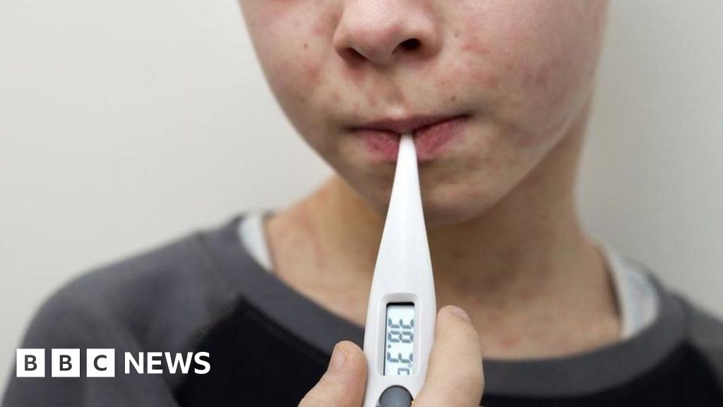 Why are measles cases rising in the UK and who can get the MMR vaccine?