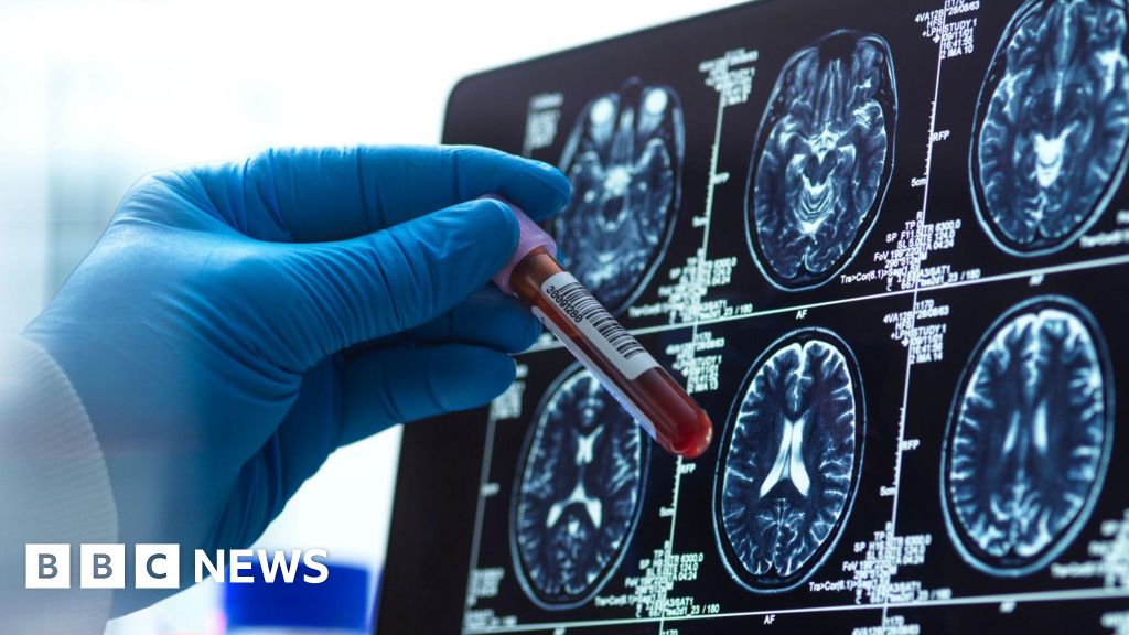 Alzheimer’s blood test could ‘revolutionise’ diagnosis